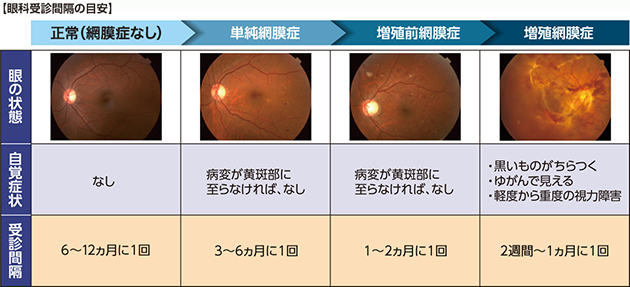 増殖性糖尿病網膜症とどう違うのですか?